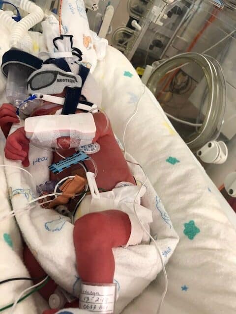 Baby Ezra born 2 months premature with heart complications.